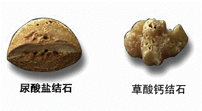 吃硒维康会导致肾结石吗(肾结石可以吃硒酵母片吗)-硒宝网