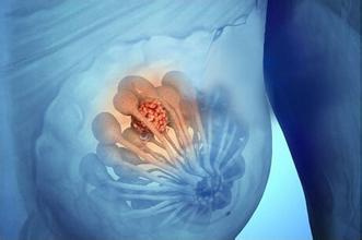 硒维康口嚼片针对乳腺癌（乳腺癌吃硒维康有效吗）-硒宝网