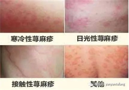 慢性荨麻疹能吃锌硒宝吗（慢性荨麻疹吃钙酸锌有效吗）-硒宝网