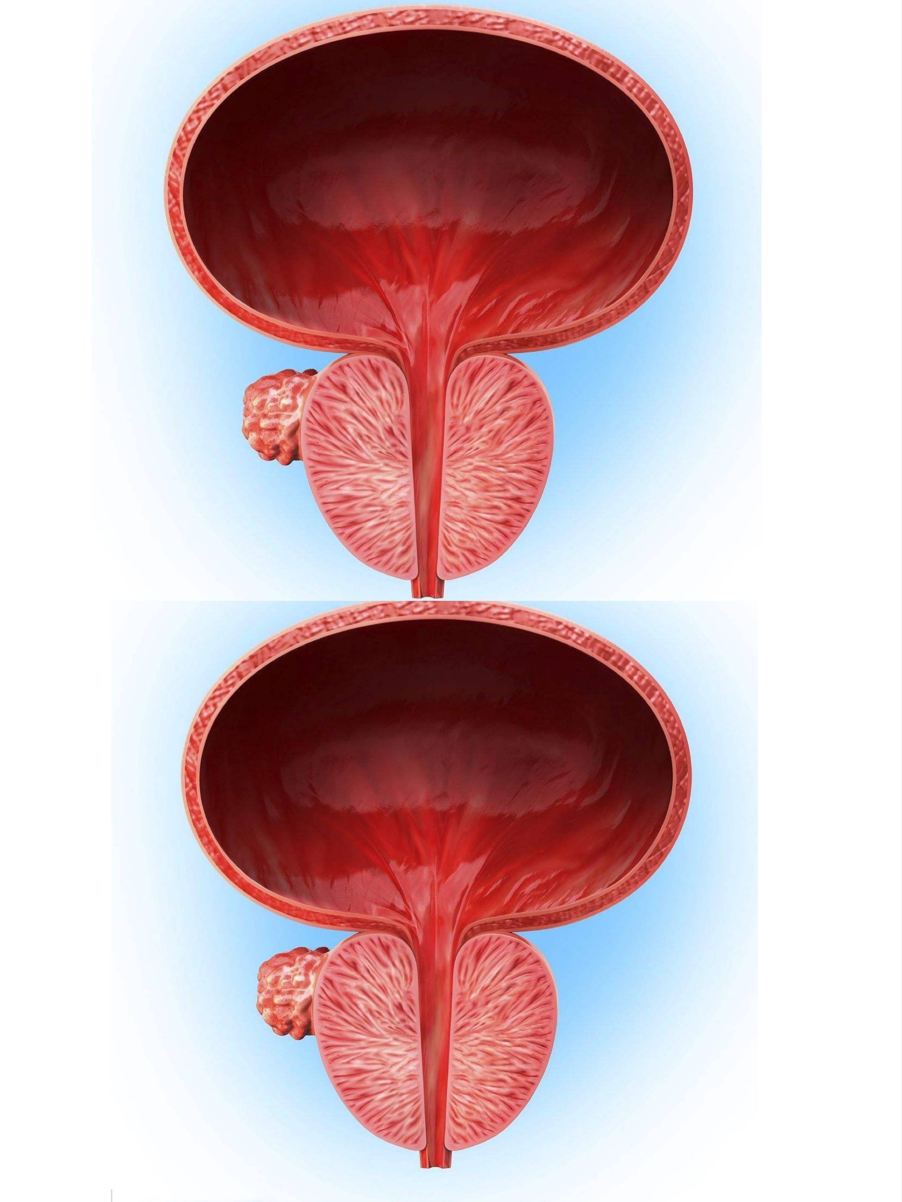 锌硒宝对前列腺炎的研究(锌硒宝前列腺炎)-硒宝网