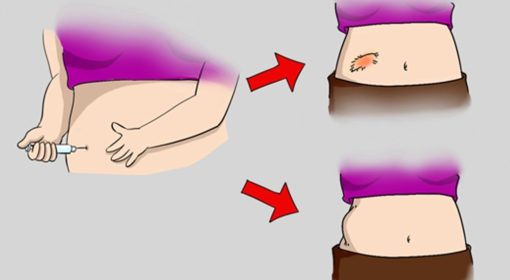 用司美格鲁肽减肥有后遗症吗(司美格鲁肽减肥效果)-硒宝网
