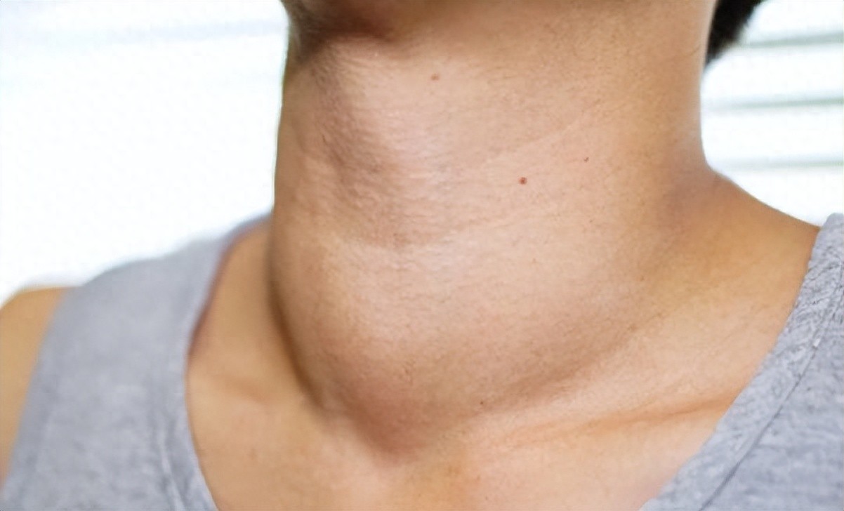 补硒可以治疗桥本甲状腺炎吗（桥本甲状腺炎吃补硒药吗）-硒宝网