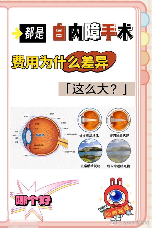 硒维康的价格（白内障手术价格）-硒宝网