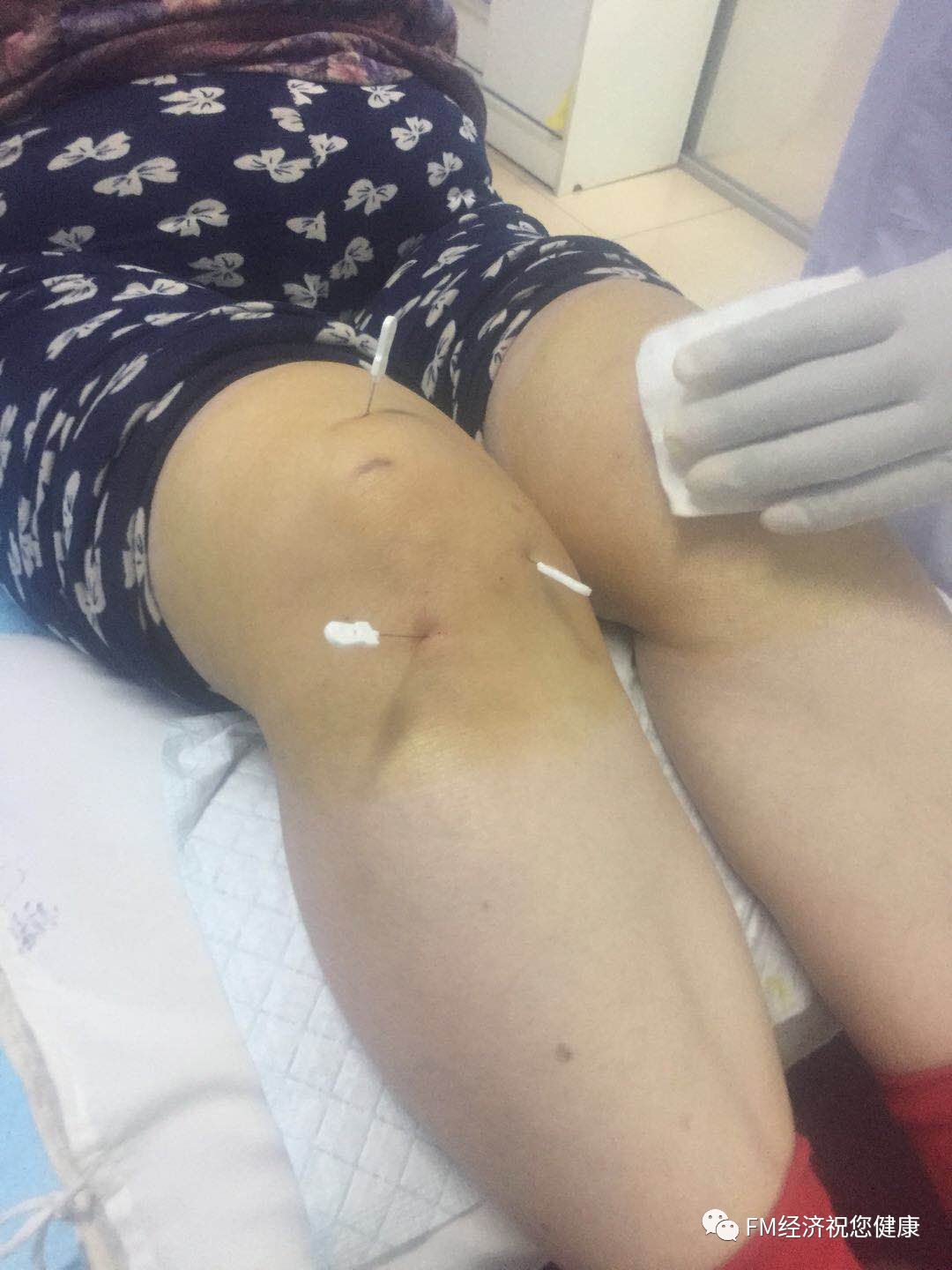 补硒治疗布?。ú悸尘≈幸街瘟疲?硒宝网