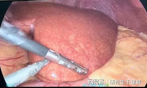 补硒会过敏吗(硒元素辅助降血脂)-硒宝网