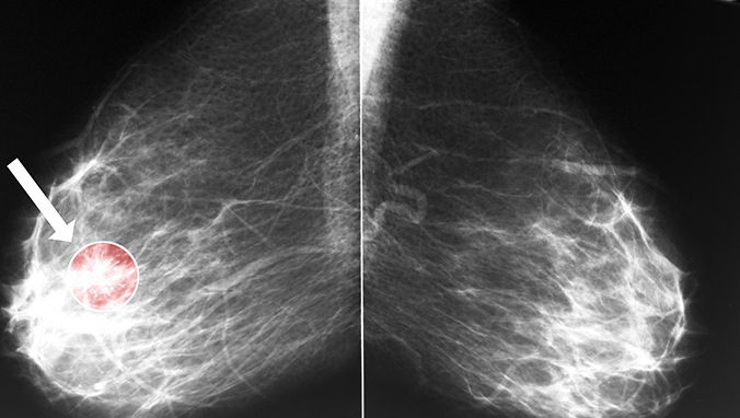 补硒 CEA（补硒预防肺癌肝转移）-硒宝网