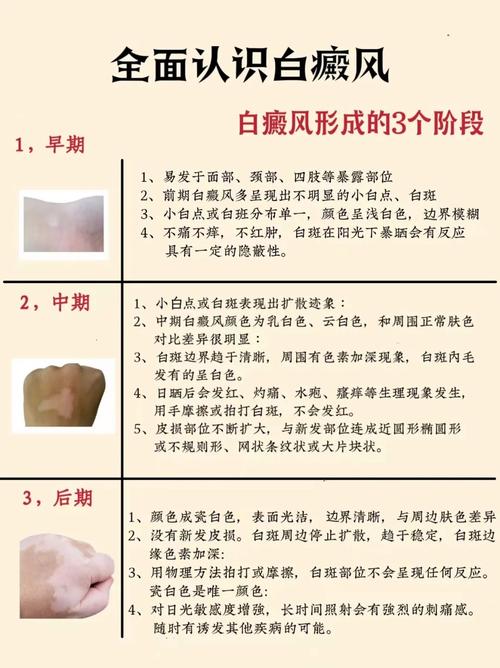 白癜风补硒吗(白癜风治疗医院选择)-硒宝网