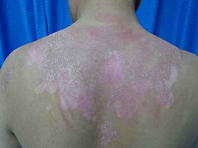 白癜风补硒吗（烟台白癜风医院排名）-硒宝网