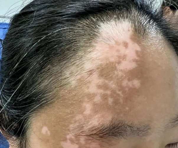 白癜风补硒吗(白癜风铁锌铜硒缺乏)-硒宝网