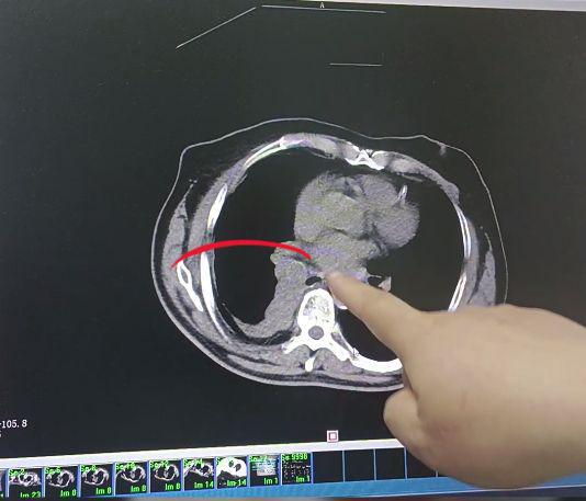肺癌怎么补硒（肺癌治疗费用构成）-硒宝网