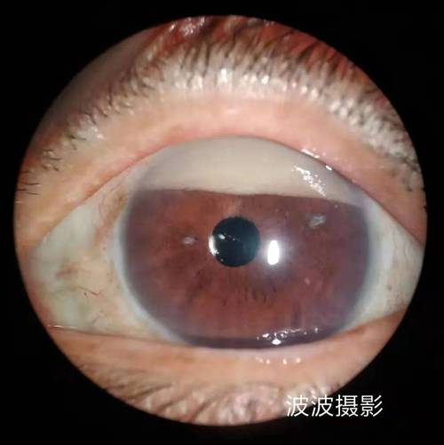 眼球突出补硒（角膜厚度与功能）-硒宝网