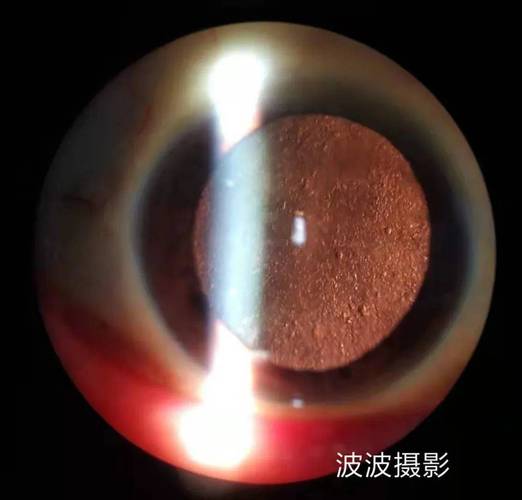 眼球突出补硒（角膜厚度与功能）-硒宝网