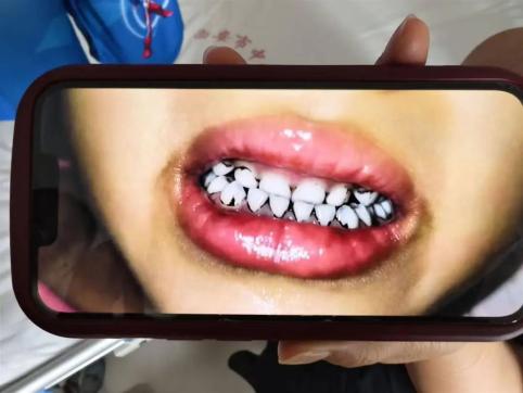 儿童补硒过多（甘肃天水幼儿园铅中毒）-硒宝网