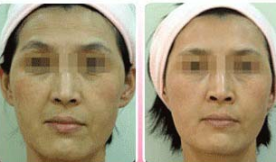 脸色发黑补硒（西红柿汁祛斑）-硒宝网