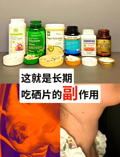 桥本补硒脱发(甲状腺功能减退症状)-硒宝网