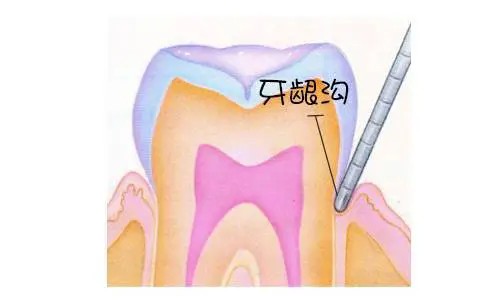 牙龈出血补硒(牙龈沟深度与牙周炎)-硒宝网