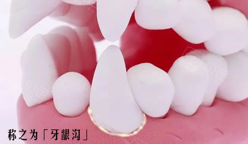 牙龈出血补硒(牙龈沟深度与牙周炎)-硒宝网