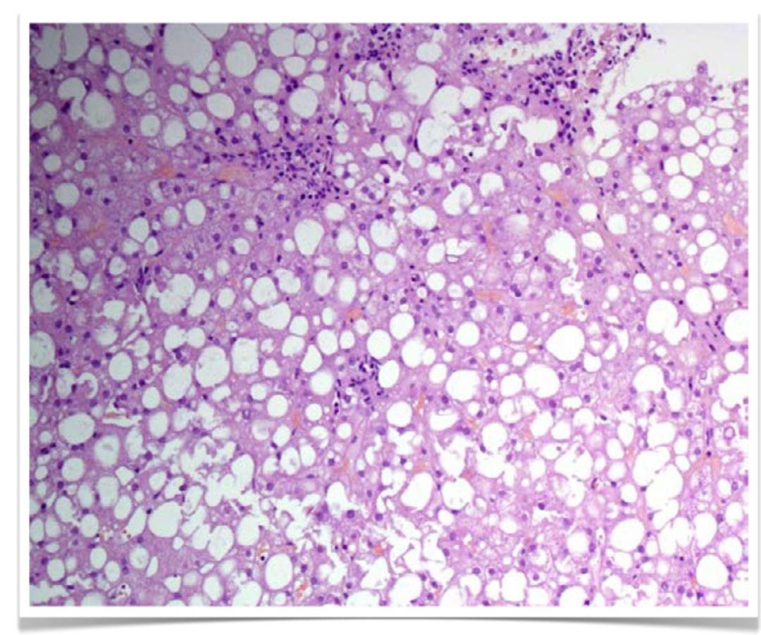 肝病补硒案例( 非典型脂肪肝误诊案例 )-硒宝网