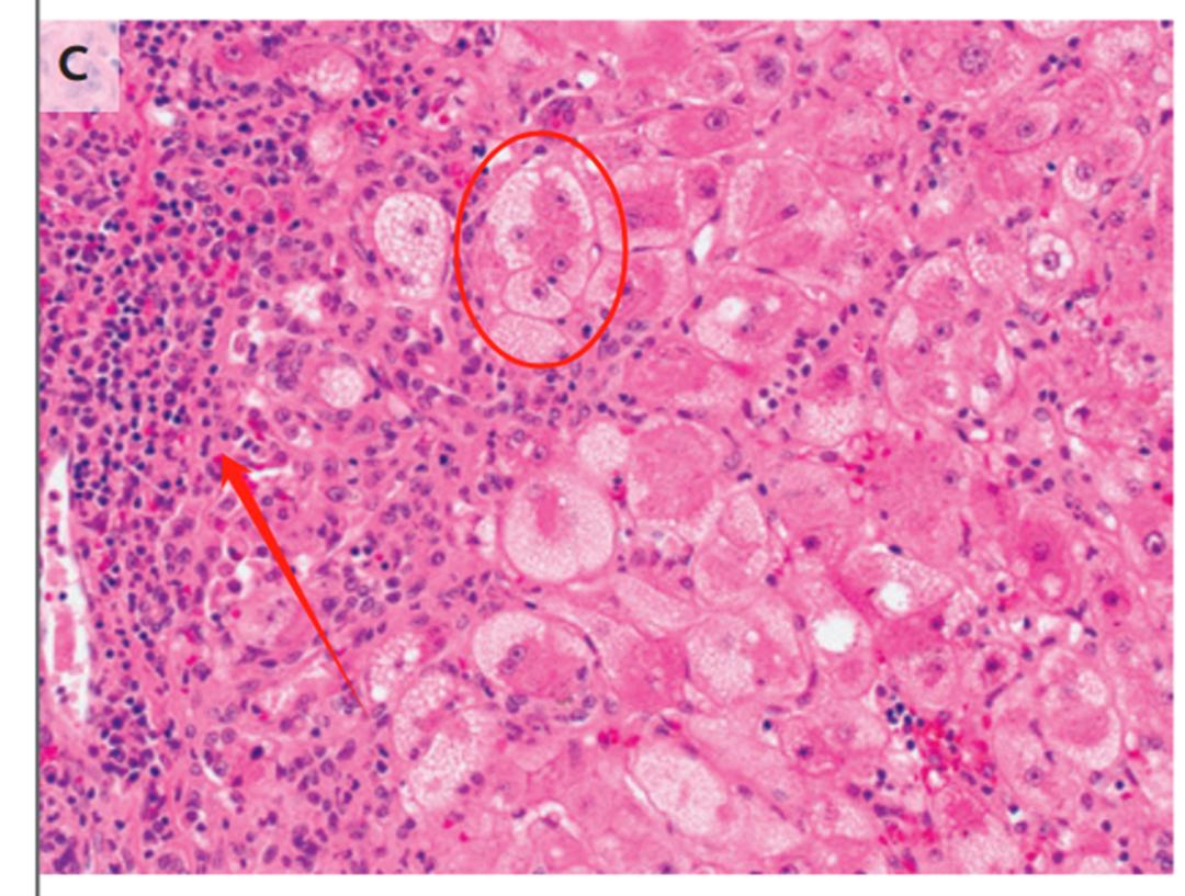 肝病补硒案例( 非典型脂肪肝误诊案例 )-硒宝网