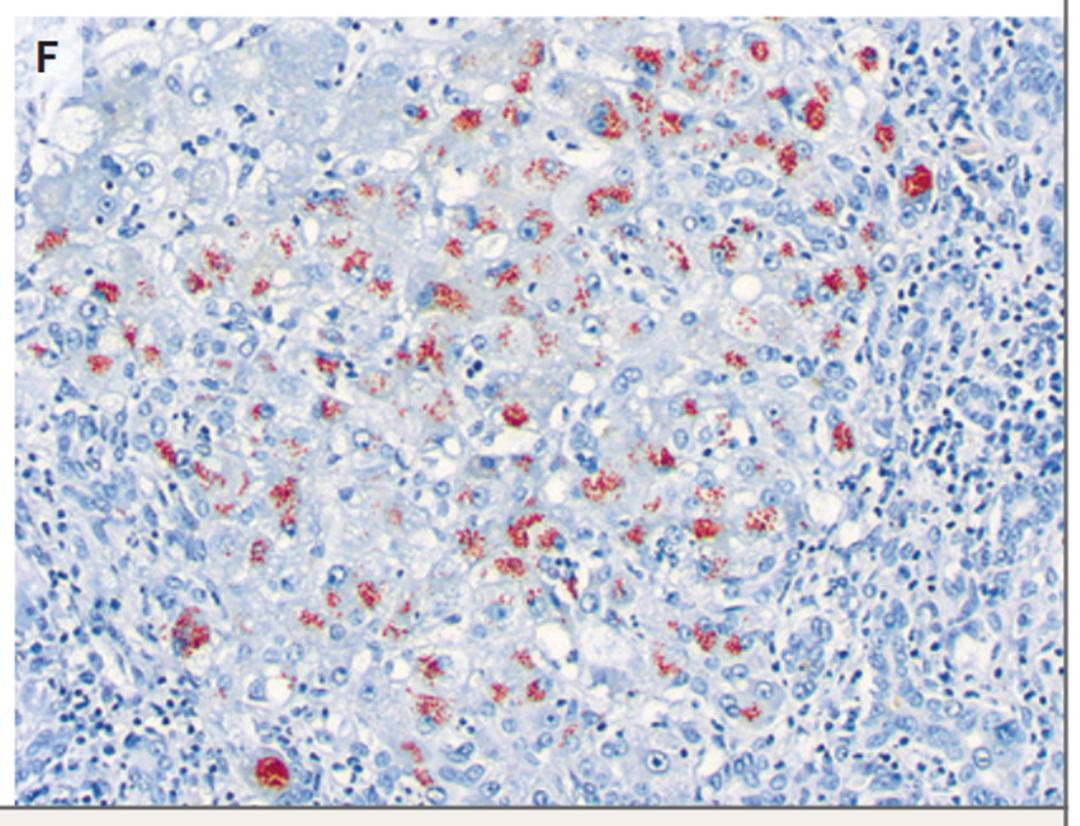 肝病补硒案例( 非典型脂肪肝误诊案例 )-硒宝网