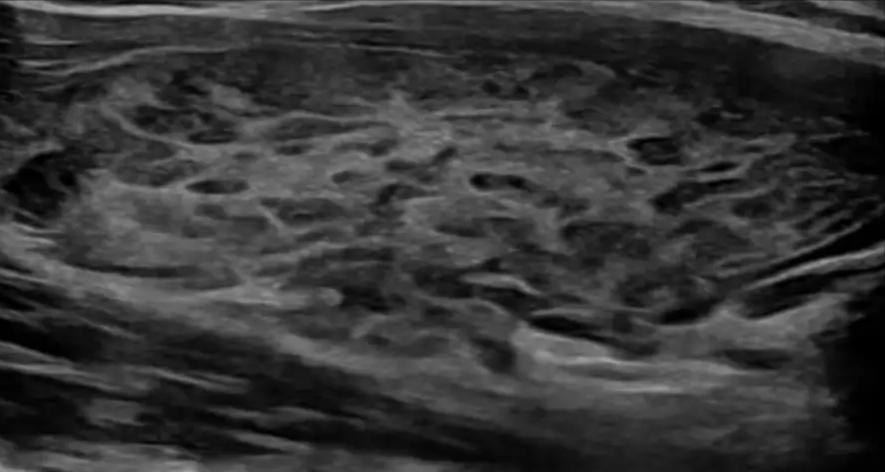 甲亢突然补硒()-硒宝网