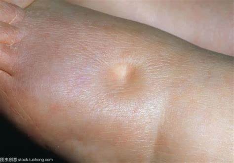 甲亢突然补硒()-硒宝网