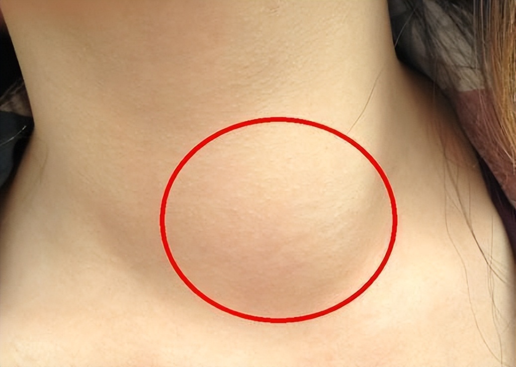 桥本抗体补硒（）-硒宝网