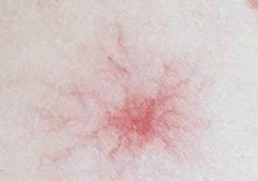 补硒治愈乙肝(长期情绪抑郁导致肝癌)-硒宝网