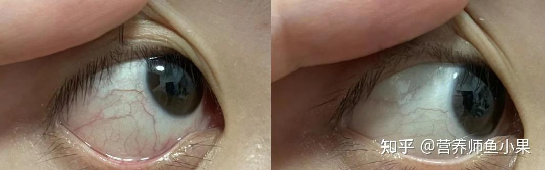 眼睛补硒价格（叶黄素酯与叶黄素区别）-硒宝网