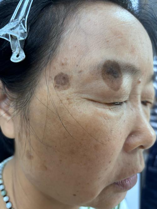 补硒导致长斑()-硒宝网