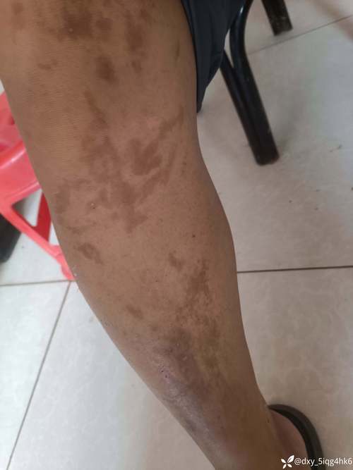 补硒导致长斑()-硒宝网