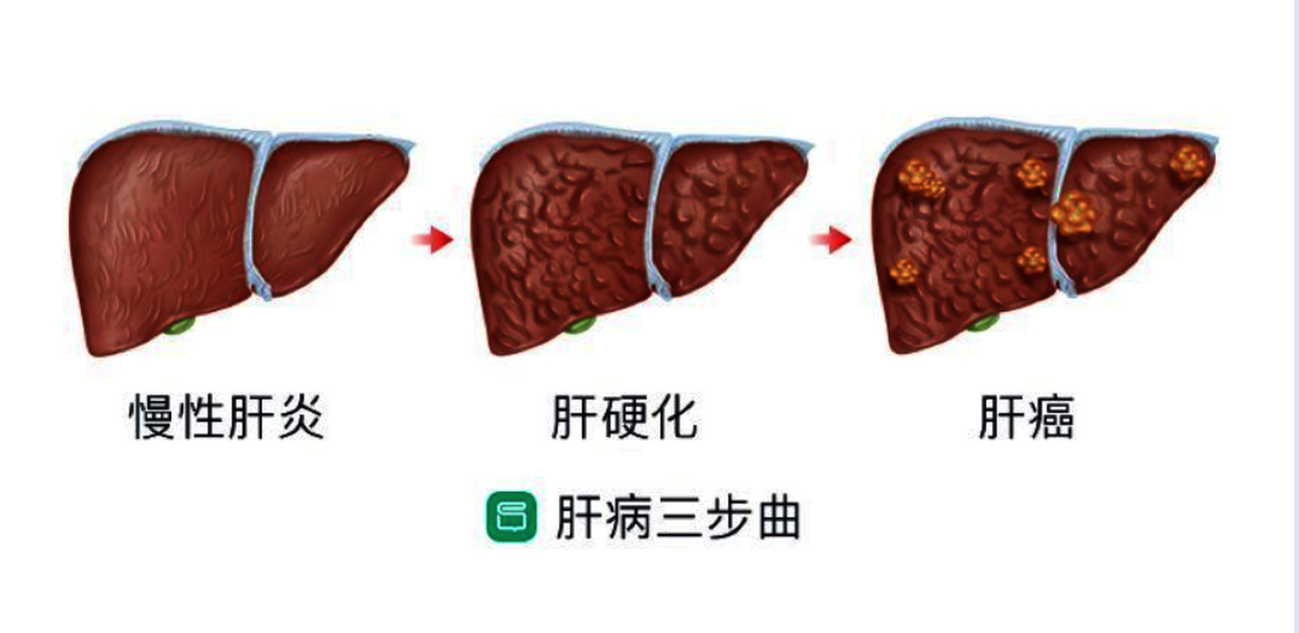 补硒年终总结（硒与肝纤维化关系研究）-硒宝网