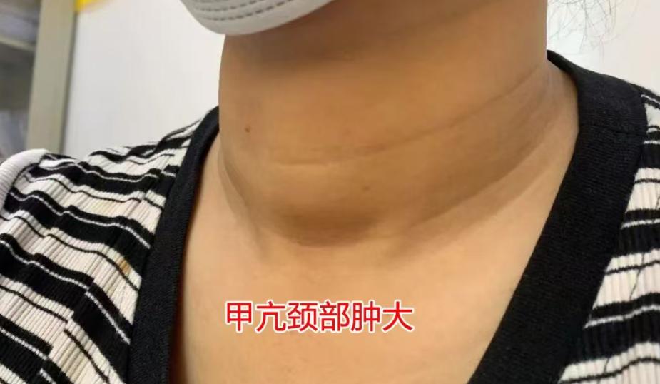 补硒降血糖吗(甲状腺饮食误区)-硒宝网