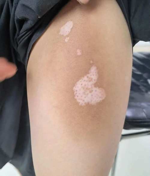 补硒 皮肤?。ㄎ氚遵胺纾?硒宝网