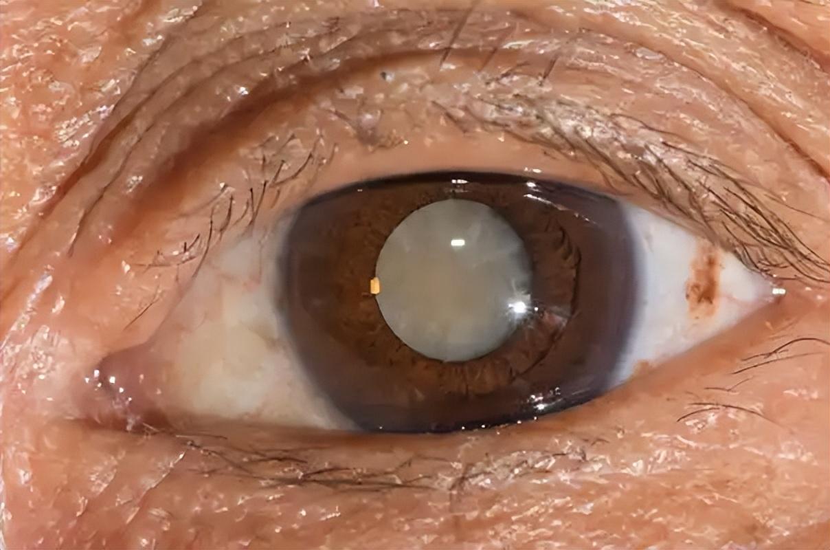 补硒后眼睛困(硒元素与眼健康)-硒宝网