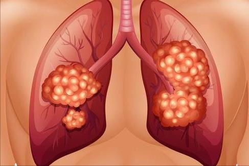 化疗后要补硒(硒摄入不足)-硒宝网